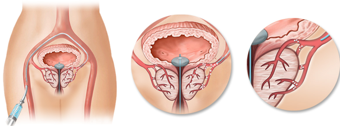 PAE to Treat an Enlarged Prostate 